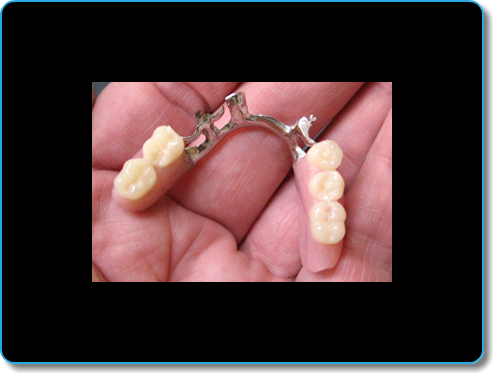 Protesis dentales 1